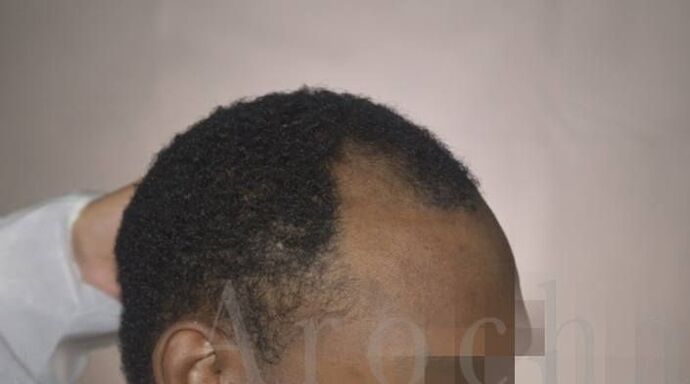 Ethnic Hair Restoration: Case 8 - Before