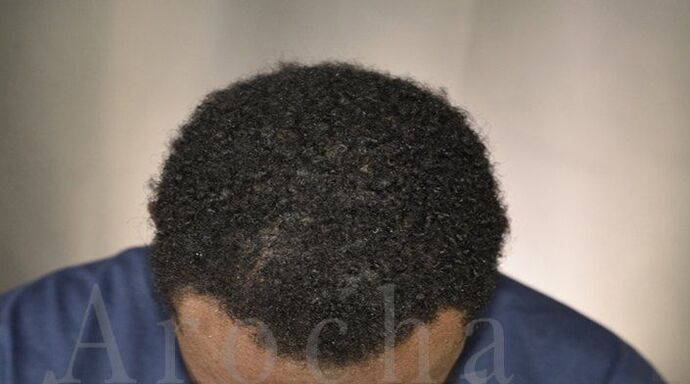 Ethnic Hair Restoration: Case 8 - After