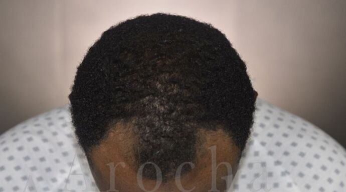 Ethnic Hair Restoration: Case 8 - Before