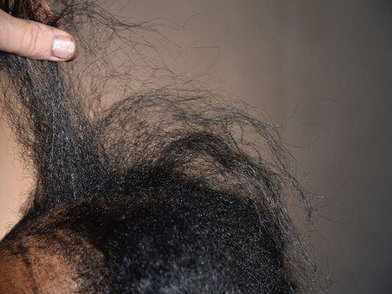 Ethnic Hair Restoration Case 9 - Before