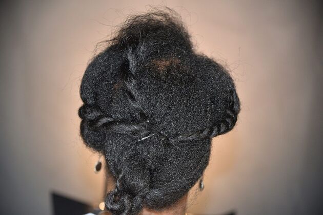 Ethnic Hair Restoration: Case 9 - Before