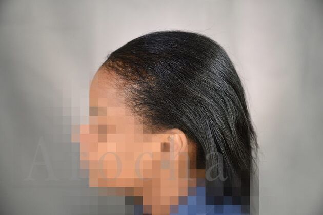 Ethnic Hair Restoration: Case 9 - After