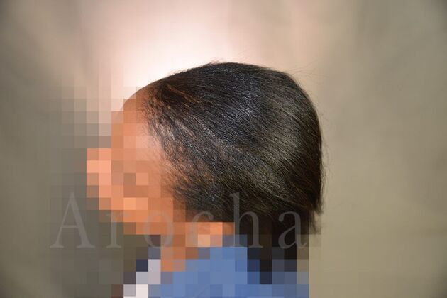 Ethnic Hair Restoration: Case 9 - After