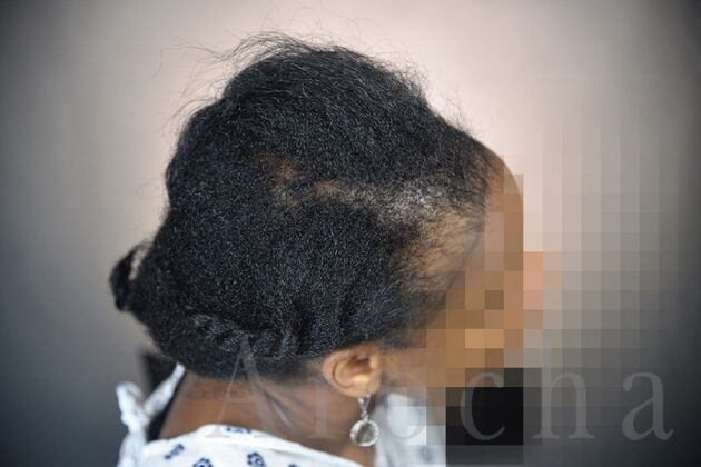 Ethnic Hair Restoration: Case 9 - Before