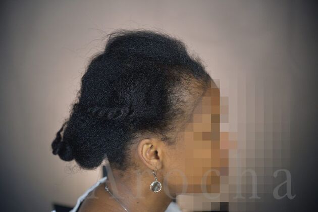 Ethnic Hair Restoration: Case 9 - Before