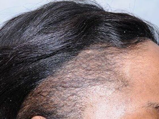 Ethnic Hair Restoration Case 10 - After