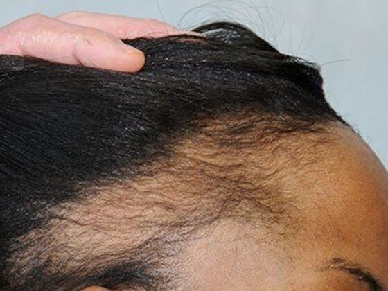 Ethnic Hair Restoration Case 10 - Before