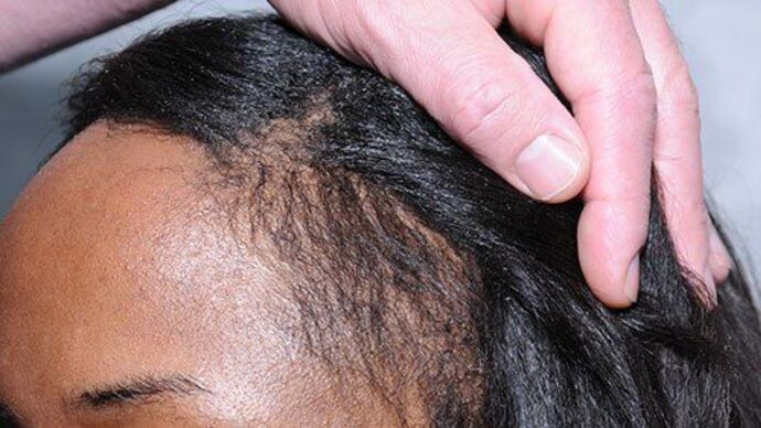 Ethnic Hair Restoration: Case 10 - After