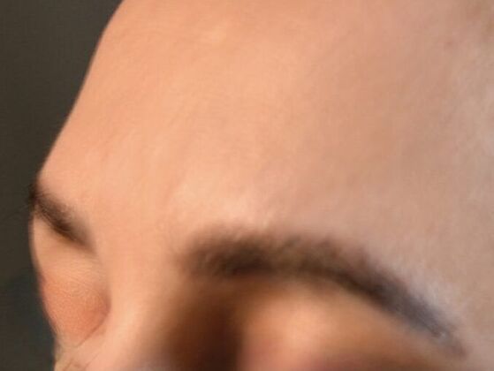 Facial Hair Transplantation: Case 4 - After