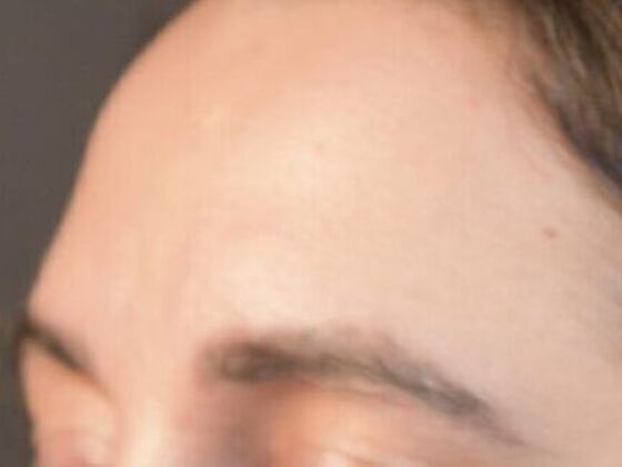 Facial Hair Transplantation: Case 4 - Before