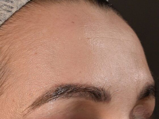 Facial Hair Transplantation: Case 4 - After