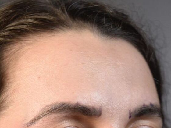Facial Hair Transplantation: Case 4 - Before
