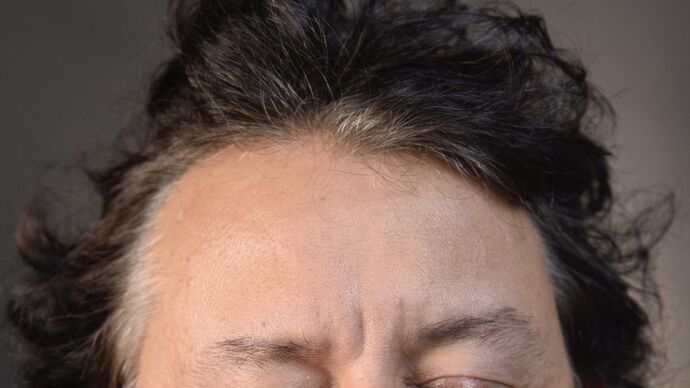 Facial Hair Transplantation Case 5 - Before