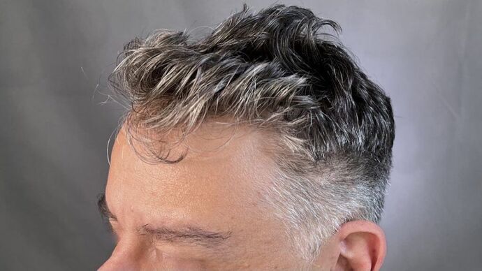 Facial Hair Transplantation: Case 5 - After