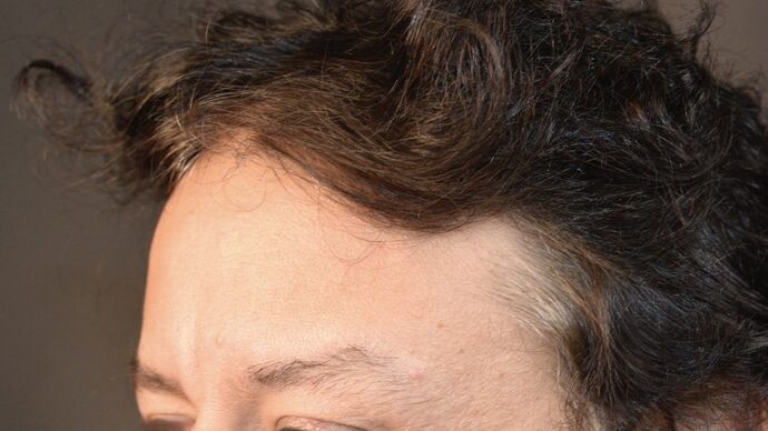 Facial Hair Transplantation: Case 5 - Before