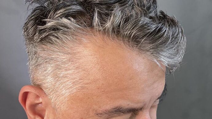 Facial Hair Transplantation: Case 5 - After