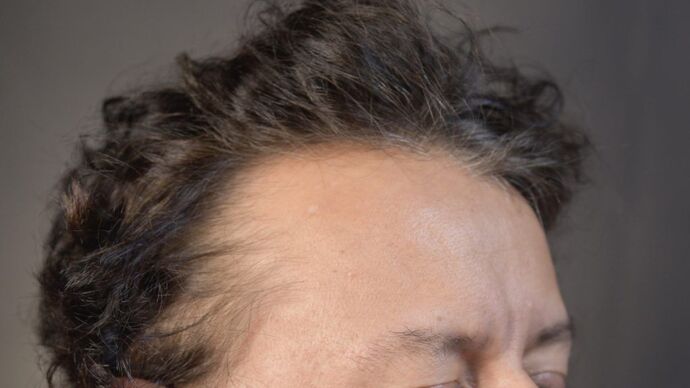 Facial Hair Transplantation: Case 5 - Before