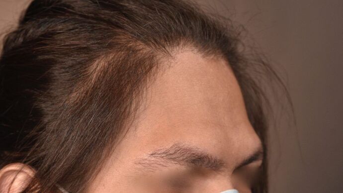 Facial Hair Transplantation: Case 6 - Before