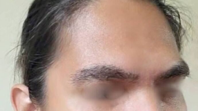 Facial Hair Transplantation: Case 6 - After
