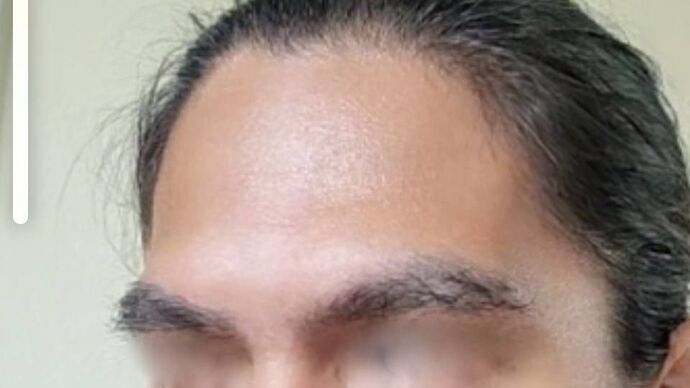 Facial Hair Transplantation: Case 6 - After