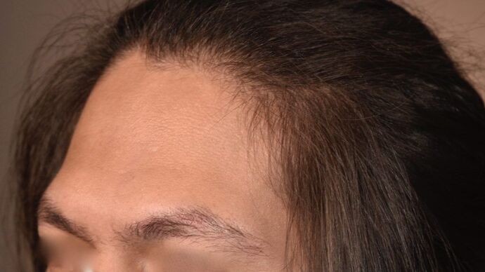 Facial Hair Transplantation: Case 6 - Before