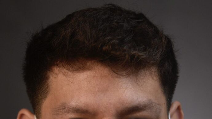 Facial Hair Transplantation Case 7 - Before
