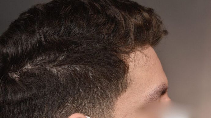 Facial Hair Transplantation: Case 7 - After