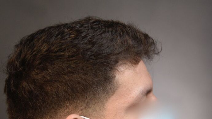 Facial Hair Transplantation: Case 7 - Before