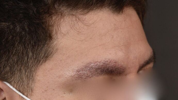 Facial Hair Transplantation: Case 7 - After