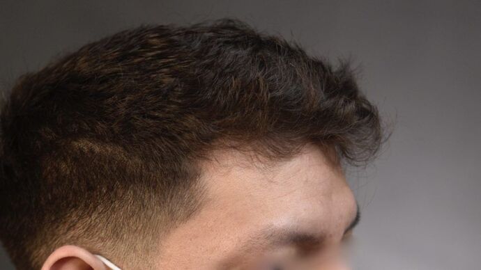 Facial Hair Transplantation: Case 7 - Before