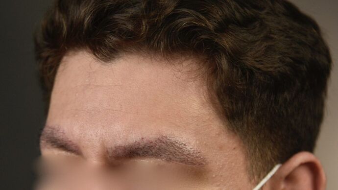 Facial Hair Transplantation: Case 7 - After