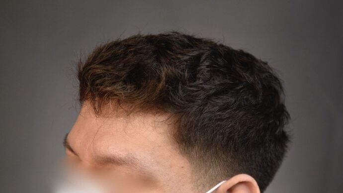 Facial Hair Transplantation: Case 7 - Before