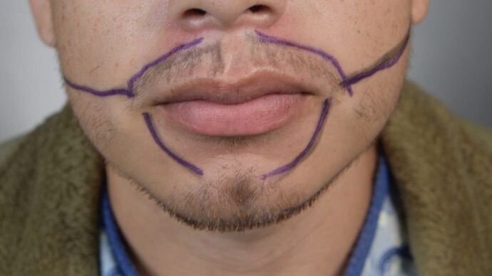 Facial Hair Transplantation: Case 8 - Before