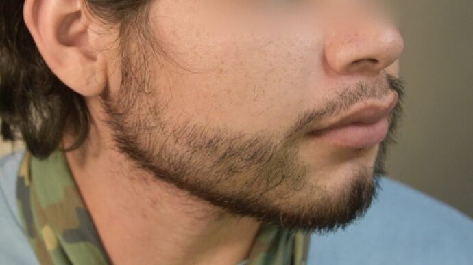 Facial Hair Transplantation: Case 8 - After