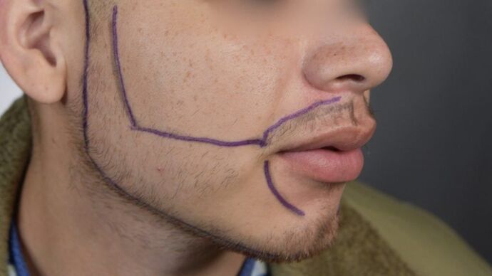 Facial Hair Transplantation: Case 8 - Before