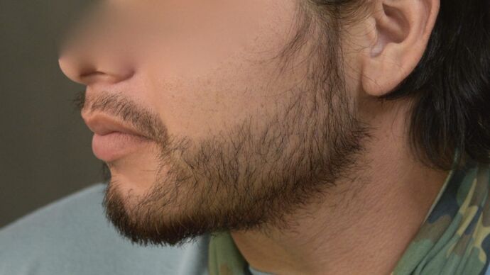 Facial Hair Transplantation: Case 8 - After