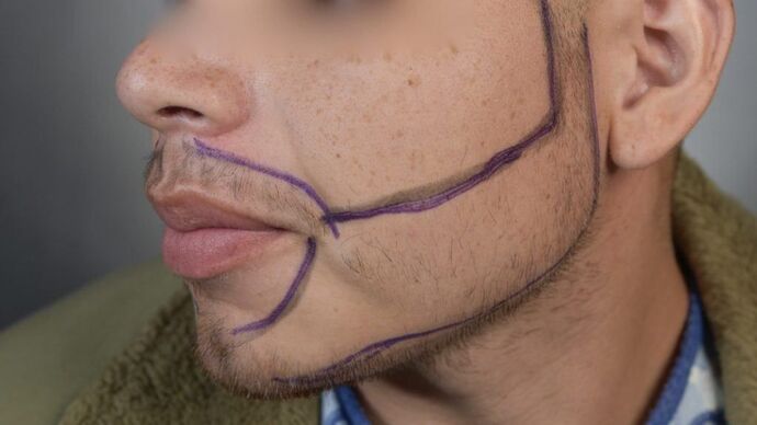 Facial Hair Transplantation: Case 8 - Before