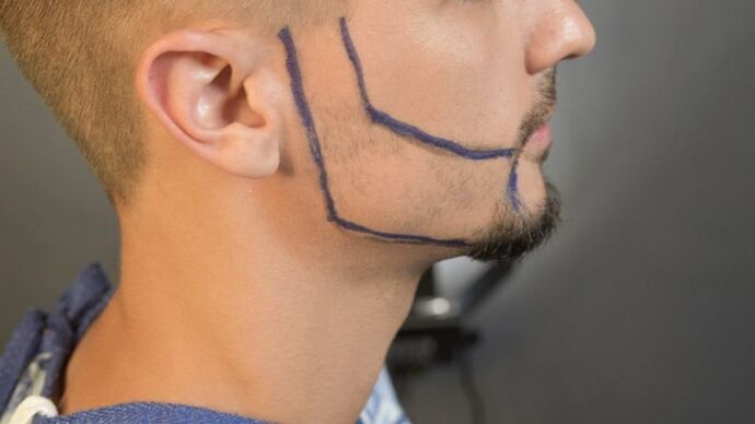 Facial Hair Transplantation Case 9 - Before