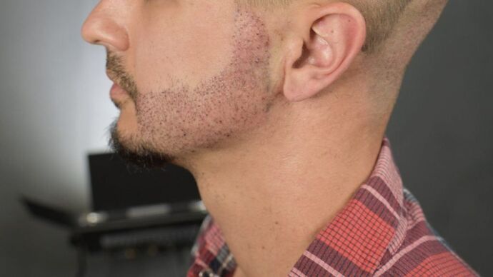 Facial Hair Transplantation: Case 9 - After