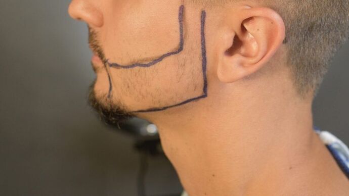 Facial Hair Transplantation: Case 9 - Before