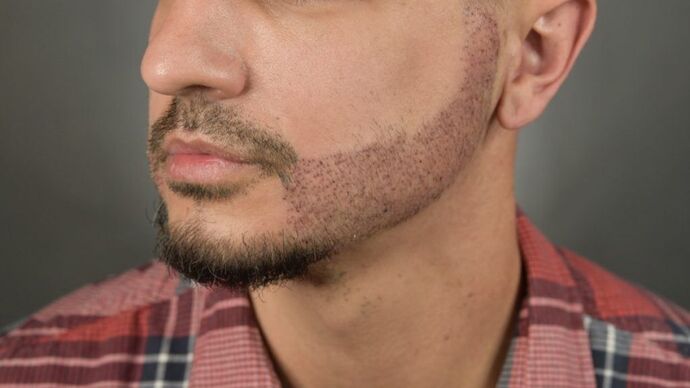 Facial Hair Transplantation: Case 9 - After