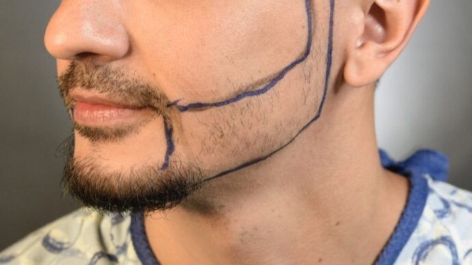 Facial Hair Transplantation: Case 9 - Before