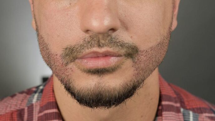 Facial Hair Transplantation: Case 9 - After