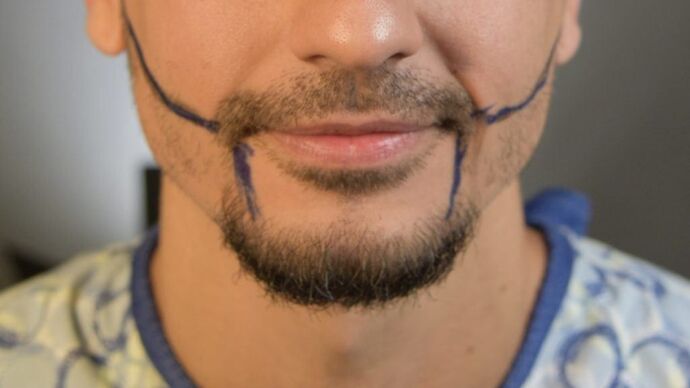 Facial Hair Transplantation: Case 9 - Before