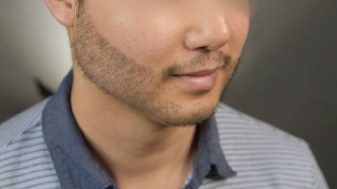 Facial Hair Transplantation: Case 10 - After