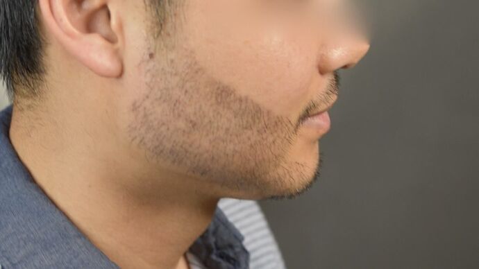 Facial Hair Transplantation: Case 10 - After