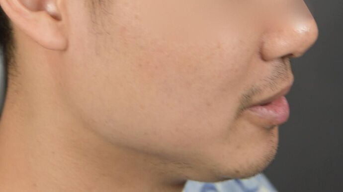 Facial Hair Transplantation: Case 10 - Before