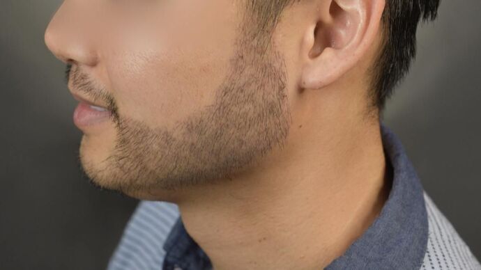 Facial Hair Transplantation: Case 10 - After