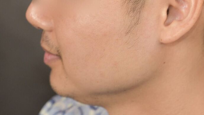 Facial Hair Transplantation: Case 10 - Before