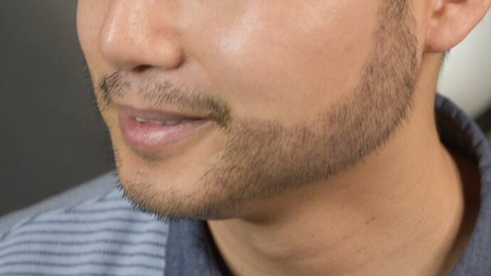 Facial Hair Transplantation: Case 10 - After
